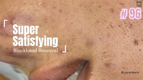 why is blackhead removal satisfying|Super Satisfying Blackhead Removal .